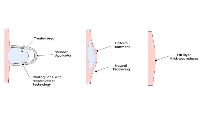 cryolipolysis